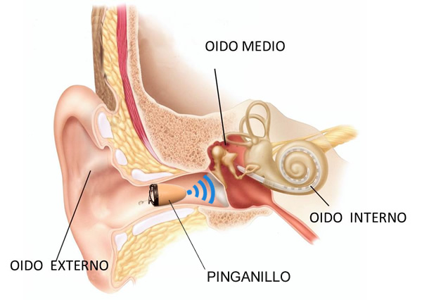 Pinganillo dentro del oído